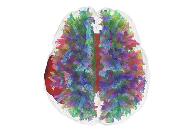 IA Interpretable en Neurooncología Decodificando la severidad tumoral mediante resonancia multimodal